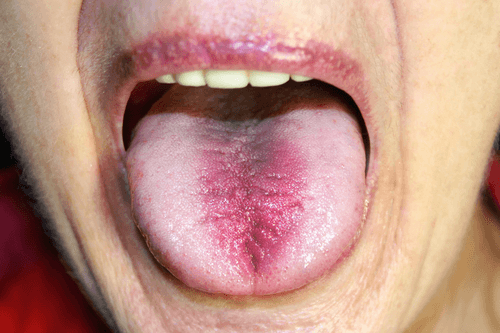 Burning mouth syndrome tongue