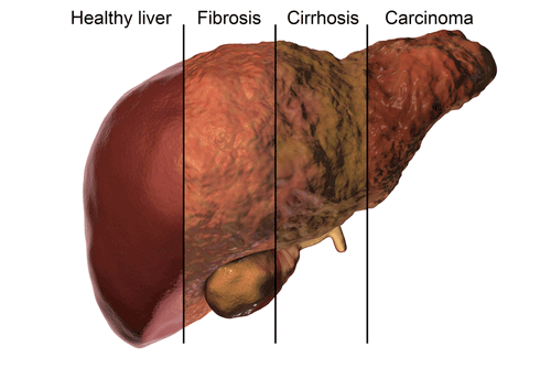 Fatty-Liver-Cirrhosis