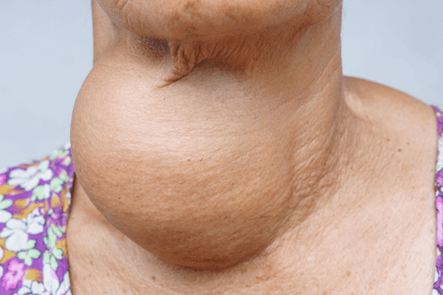 Hyperthyroidism goitre