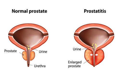 a prostatitis fáj a combot)