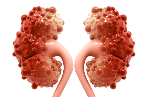 new research about polycystic kidney disease