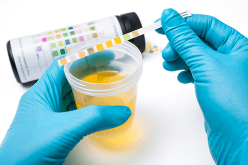 Proteinuria urine sample