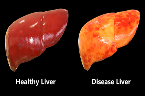 fatty vs healthy liver