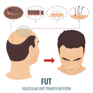 male pattern baldness