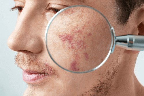 Birthmark maginified