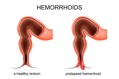 Rectal Prolapse Symptoms Causes Remedies Prevention FactDr   Rectal Prolapse Diagram 