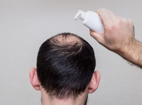 topical medication for alopecia