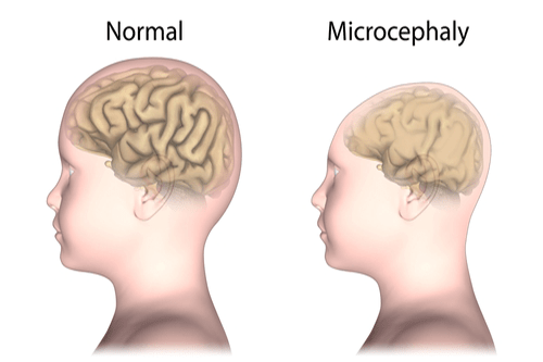 Microcephaly : Causes, transmission, symptoms, & prevention | FactDr