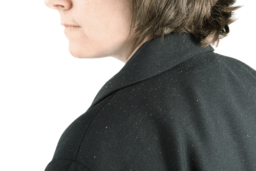 Seborrhoeic dermatitis dandruff