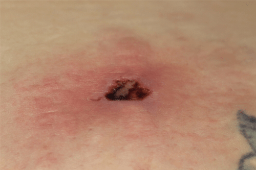 Spider Bites Pictures