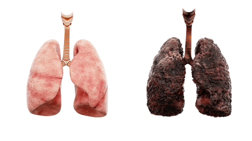 healthy vs emphysema lungs