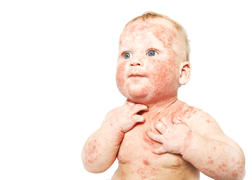 eczema in babies