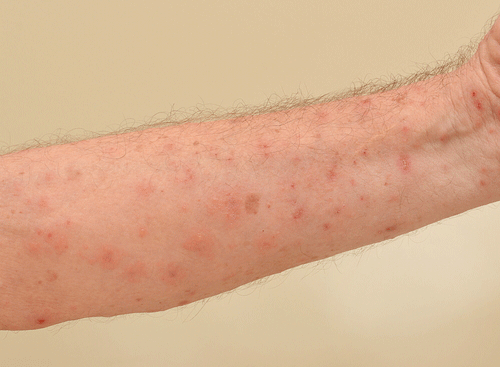 scabies rashes
