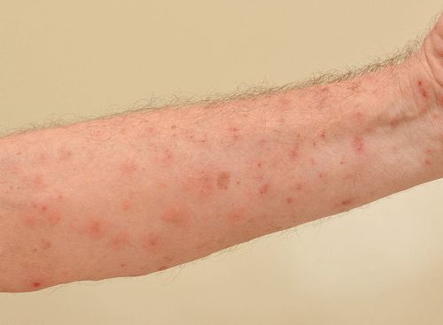 Scabies Overview Infestation Spread Treatment Prevention Factdr