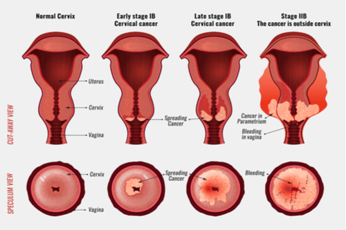 Abnormal bleeding not period new arrivals