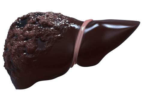 ACUTE LIVER FAILURE cancer