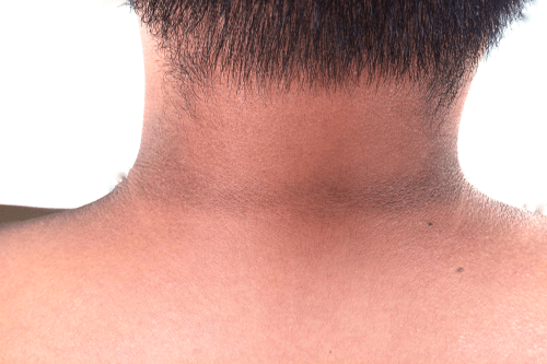 Acanthosis nigricans neck