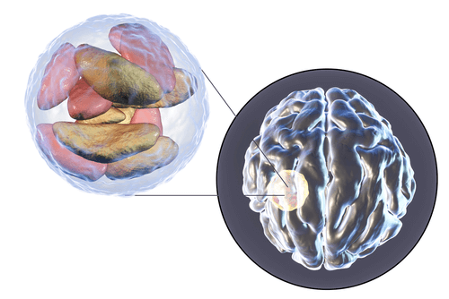 BRAIN CYSTS abscess