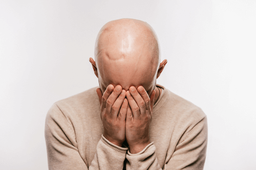 Baldness in men