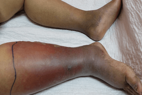 CELLULITIS legs