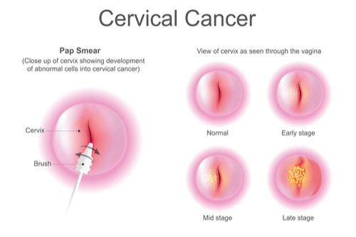 What is cervical nabothian cyst?