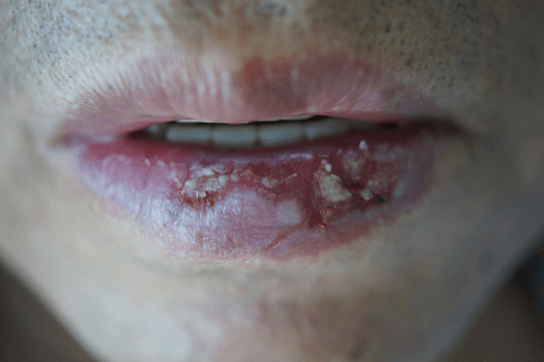Cheilitis and cracked lips