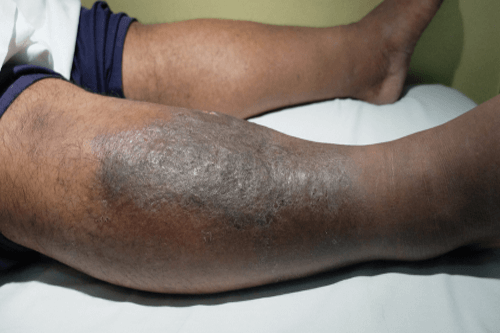 Deep Vein Thrombosis Symptoms Causes Diagnosis Treatment Factdr