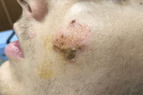 nasal impetigo