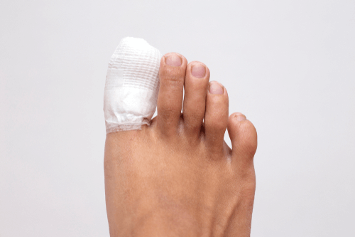 Ingrown toenail healing