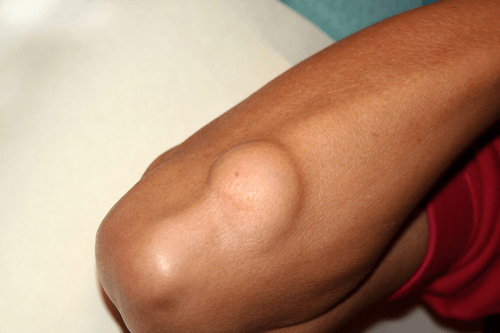 LIPOMA elbow