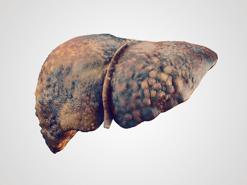 Liver cirrhosis realistic