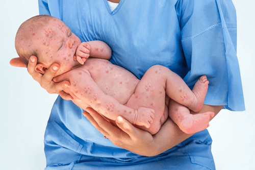 Measles newborn