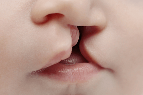 Orofacial cleft baby