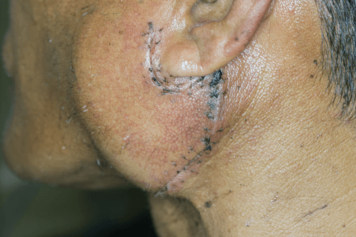 Salivary gland Infection surgery