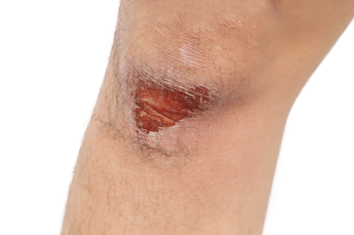 Thrombophilia injury