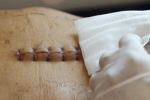 Wound debridement stitches