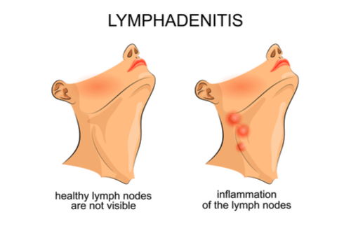 lymphoma swollen nodes