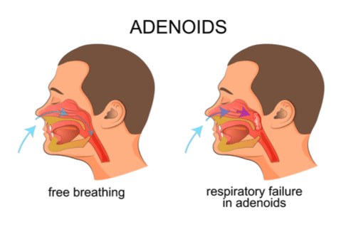 adenoiditis-facts-causes-risk-factors-complications-treatment