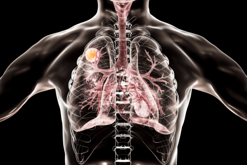 ASPERGILLOMA in lungs