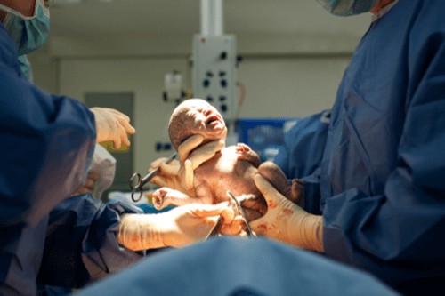 BIRTH ASPHYXIA c-section