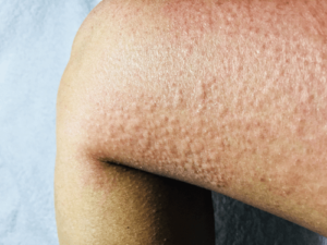 Cold Intolerance Foot Cold Intolerance: Causes, symptoms, complications, & remedies | FactDr
