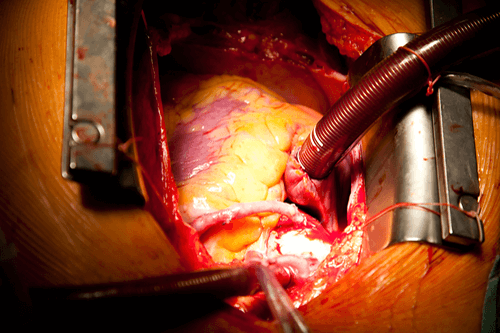 CORONARY ARTERY DISEASE surgery