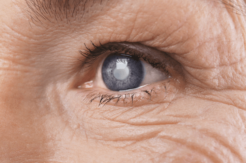 Cataract aged lady