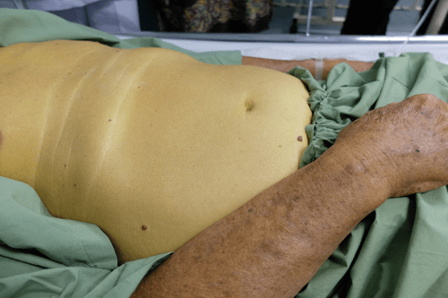 Enlarged liver jaundice