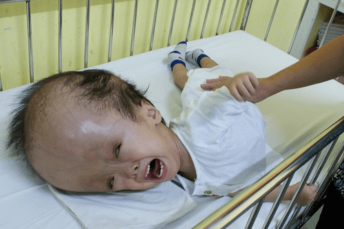 Hydrocephalus Baby