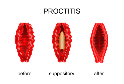 Prostatitis vagy proctitis