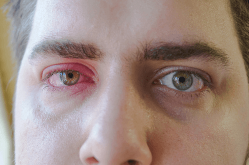 CAVERNOUS SINUS THROMBOSIS eyes