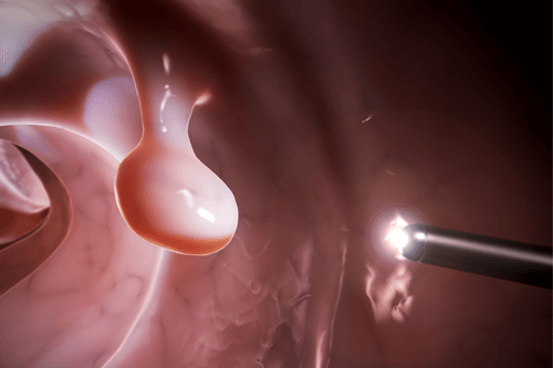 COLON POLYPS colonoscopy