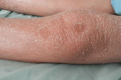 Dry skin: Facts, causes, symptoms, types, treatment, & prevention ...