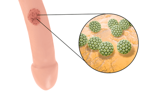 Genital Herpes Facts Causes Symptoms Care